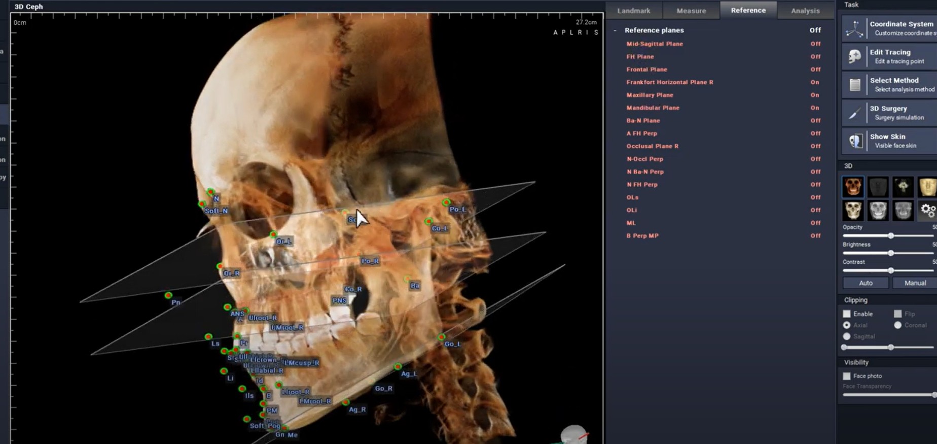 3D Ceph Tracing in HDXWill’s Orthodontic Analysis Software
