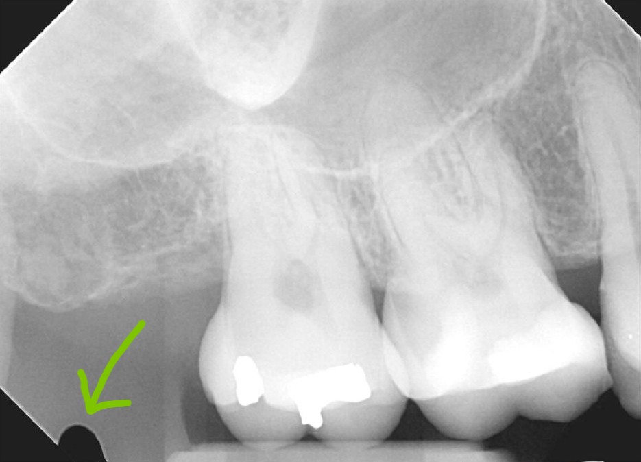 Example of delamination artifact on intraoral radiograph.