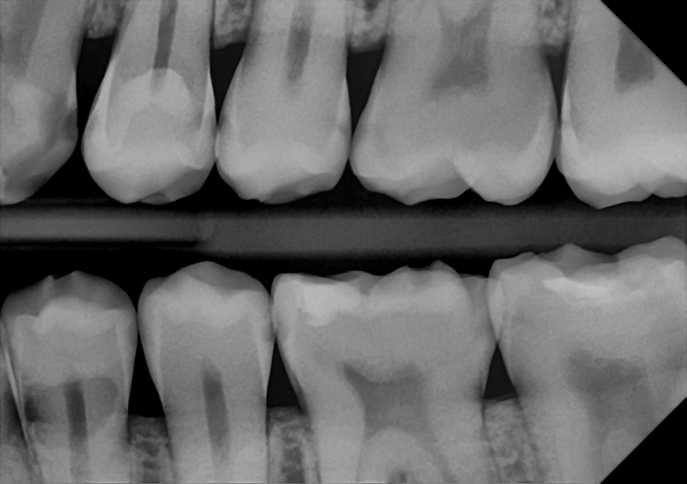 The DC-Air™ direct conversion dental X-ray sensor captures images with high accuracy.