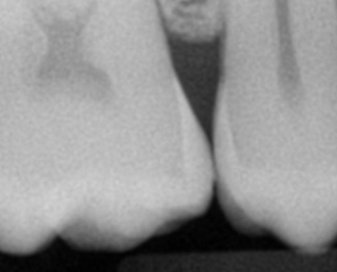 Traditional FOP dental X-ray sensor interproximal contact.