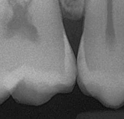 The DC-Air™ dental X-ray sensor same interproximal contact - incipient lesion.