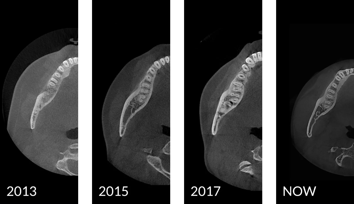Axial slices showing the evolution of HDX Will’s Cyoptix Processing Algorithm Over the Years