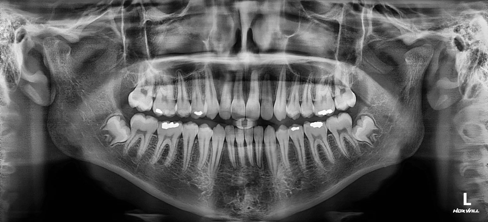 Panoramic radiograph of a full adult dentition captured on an HDX Will Dentri system