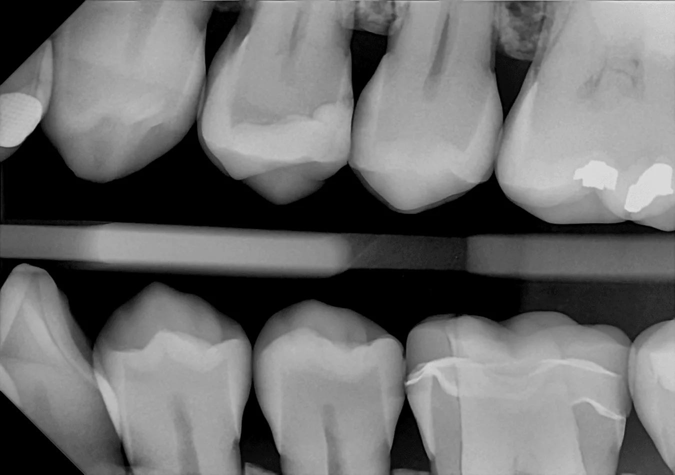 The same radiograph captured with the DC-Air direct-conversion sensor, showing greater clarity and detail
