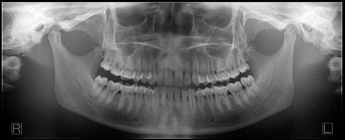 Yoshida Panoura 18S panoramic X-ray system
