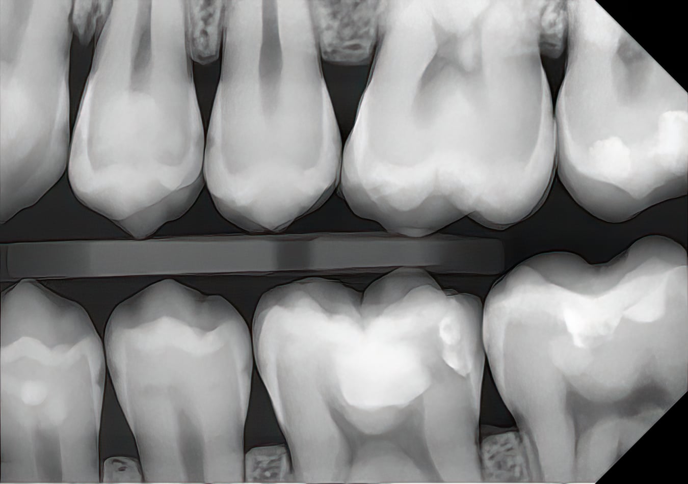 Unfiltered DC-Air bitewing radiograph showing rampant decay at high magnification — enamel, dentin, and lesion detail